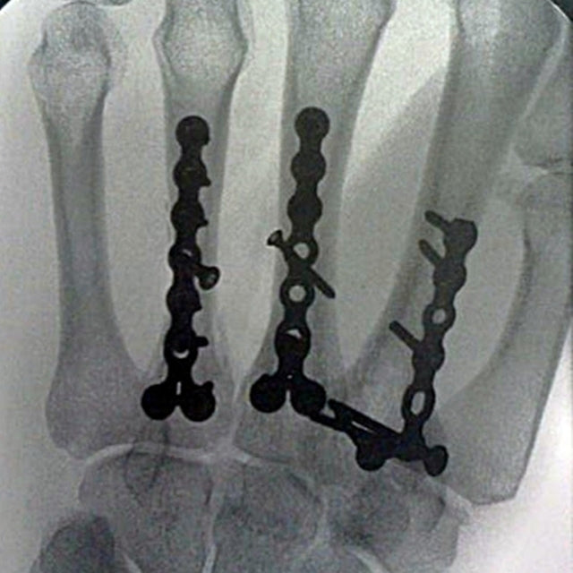 X-ray of hardware of screws and plates in hand, by Susan Carlson of Felted Button | Colorful Crochet Patterns